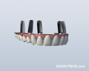 implant-retained-upper-denture
