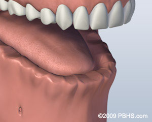 lower-jaw-all-teeth-missing-before-bar-attachment-denture