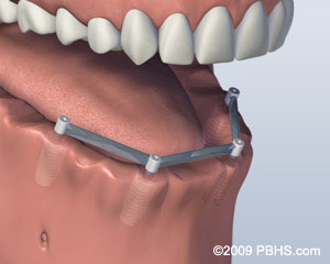 lower-jaw-all-teeth-missing-with-four-implants-for-bar-attachment-denture