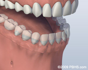 mouth-with-bar-attachment-denture-secured-onto-lower-jaw-by-four-implants
