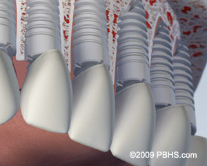 upperimplants