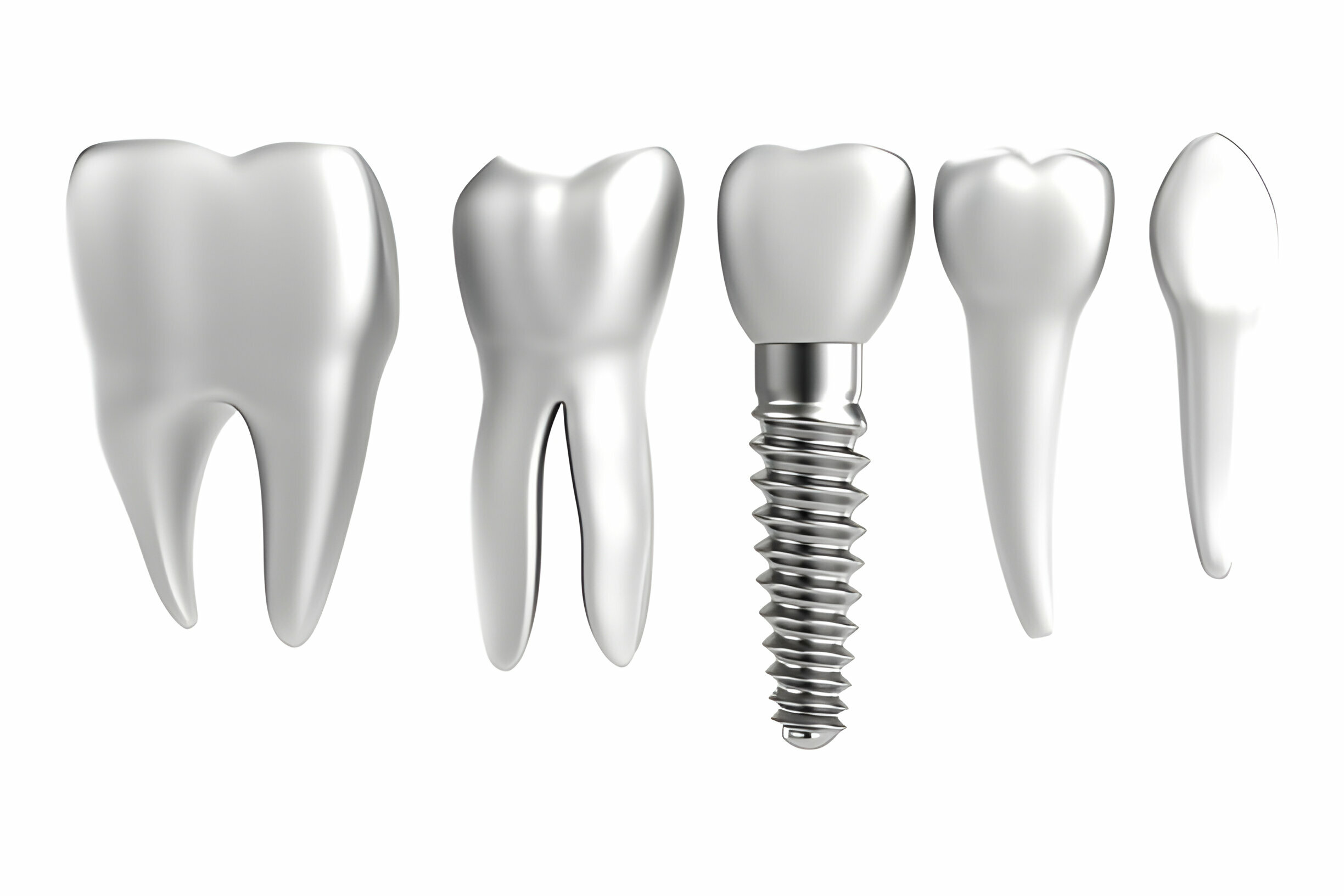 Exploring the Benefits of Dental Implants in Missouri_1