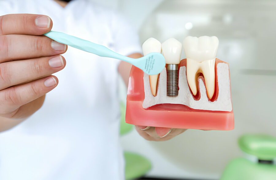 How To Choose The Right Dental Implants In Missouri_1