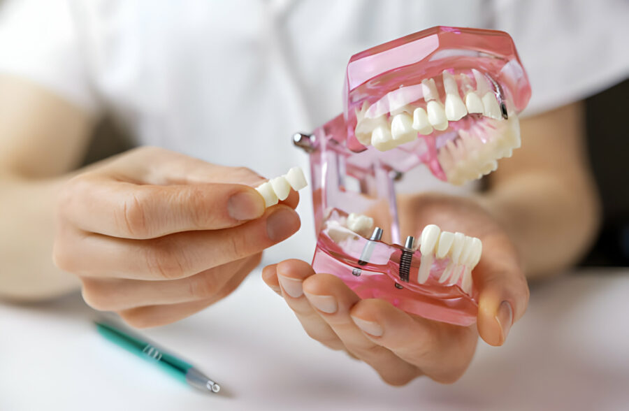 How To Choose The Right Dental Implants In Missouri_3