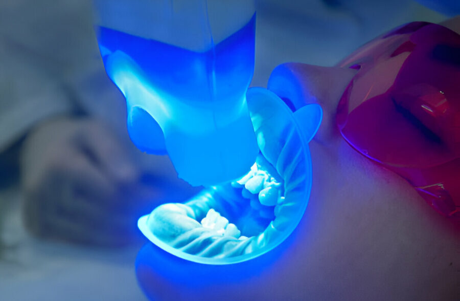 Teeth Whitening in Branson, MO: Comparing In-Office vs. At-Home Treatments at Branson Dental Center_2