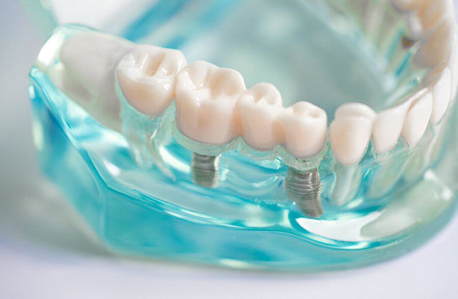 Essential Tips for Caring for Your Dental Implants in Branson, MO